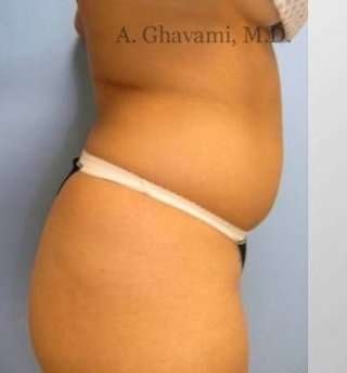 Liposuction before and after - before