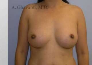 Procedure before and after - after