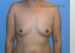Procedure before and after - before