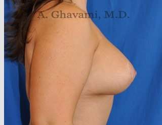 Procedure before and after - after