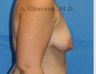 Procedure before and after - before