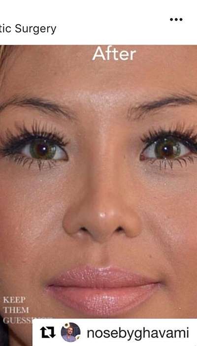Rhinoplasty before and after - after