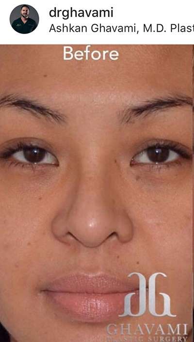 Rhinoplasty before and after - before