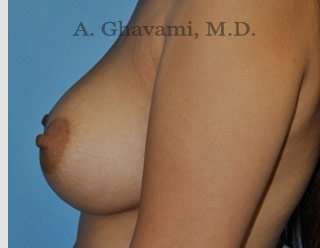 Procedure before and after - after