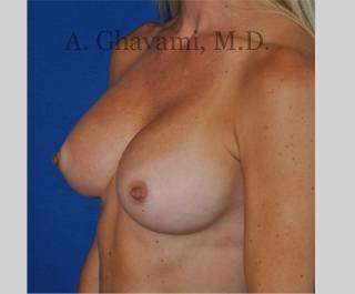 Procedure before and after - after
