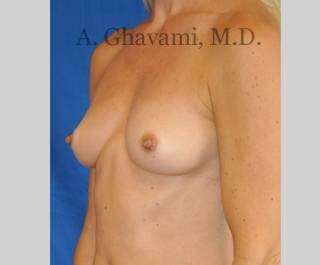 Procedure before and after - before