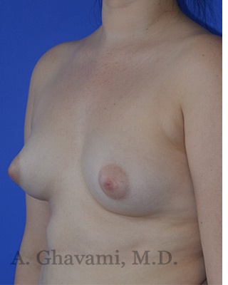 Procedure before and after - before