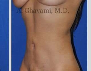 Liposuction before and after - after