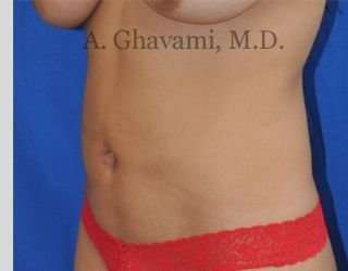 Liposuction before and after - before