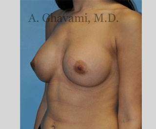 Procedure before and after - after