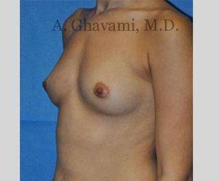 Procedure before and after - before