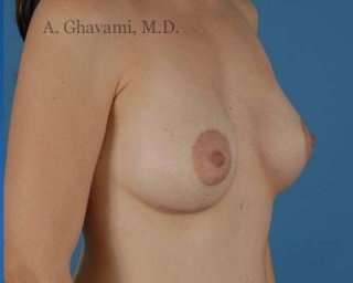 Procedure before and after - after