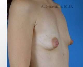 Procedure before and after - before