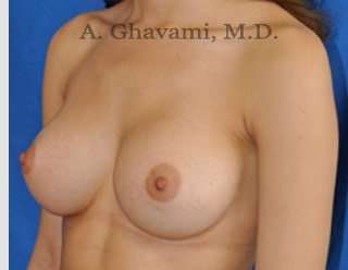 Procedure before and after - after