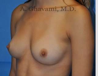 Procedure before and after - before