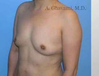 Procedure before and after - before
