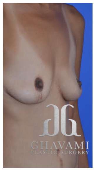 Procedure before and after - before
