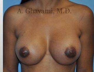 Procedure before and after - after