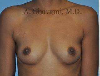 Procedure before and after - before