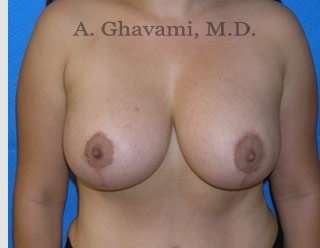 Procedure before and after - after