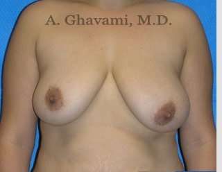 Procedure before and after - before