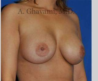 Procedure before and after - after