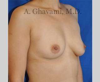 Procedure before and after - before