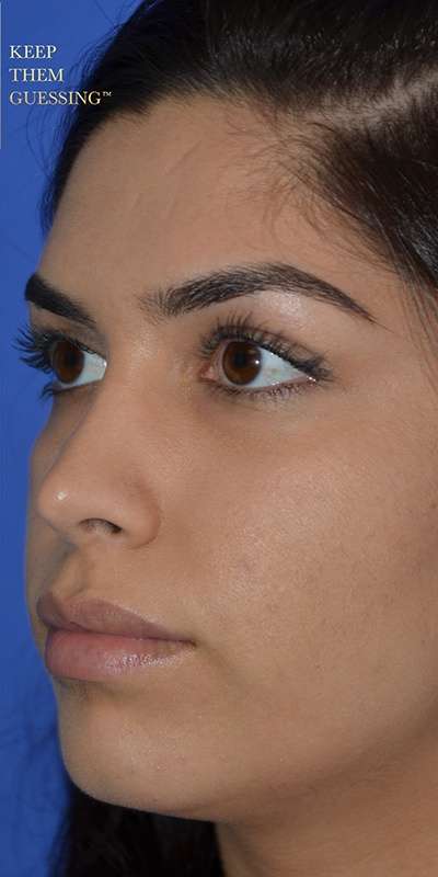 Rhinoplasty before and after - after