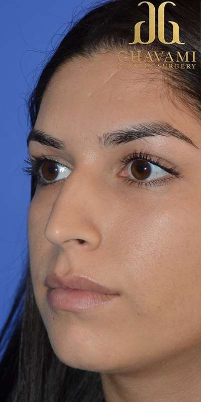 Rhinoplasty before and after - before