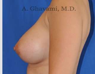Procedure before and after - after