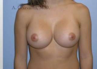 Procedure before and after - after