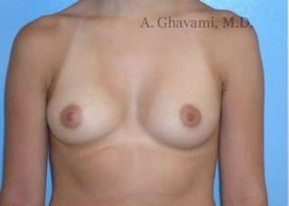 Procedure before and after - before
