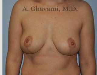 Procedure before and after - after