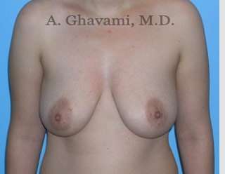 Procedure before and after - before