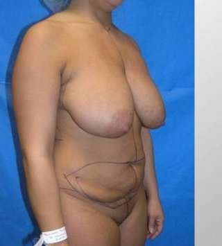 Mommy Makeover before and after - before