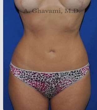 Liposuction before and after - after