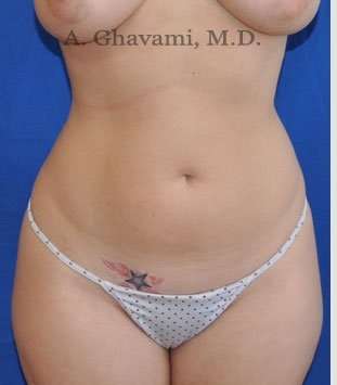Liposuction before and after - before