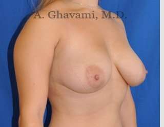 Procedure before and after - before