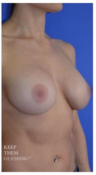 Procedure before and after - after