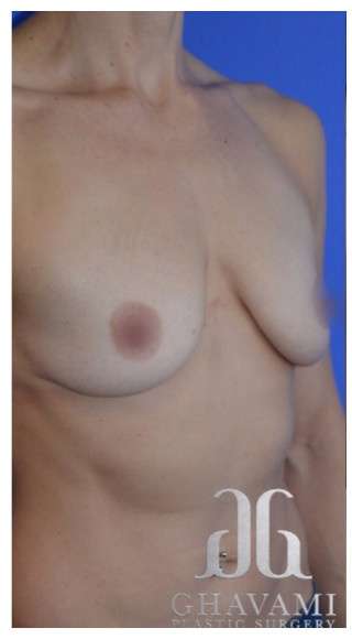 Procedure before and after - before