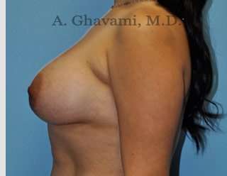 Procedure before and after - after