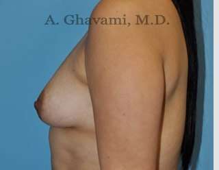 Procedure before and after - before