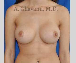 Procedure before and after - after
