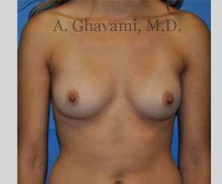 Procedure before and after - before
