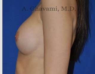 Procedure before and after - after