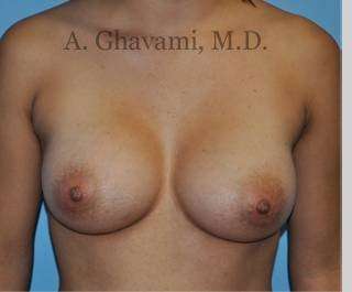 Procedure before and after - after