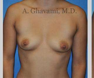 Procedure before and after - before