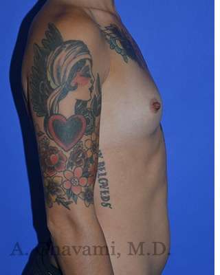 Procedure before and after - before