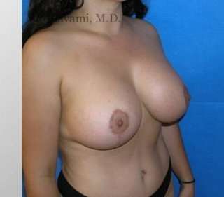 Procedure before and after - after