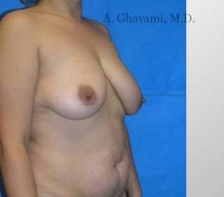 Procedure before and after - before